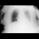 Nasogastric tube in pleural cavity, pneumothorax, pleural effusion: X-ray - Plain radiograph